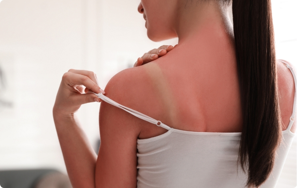 Ως λάδι για μετά το ηλιακό έγκαυμα